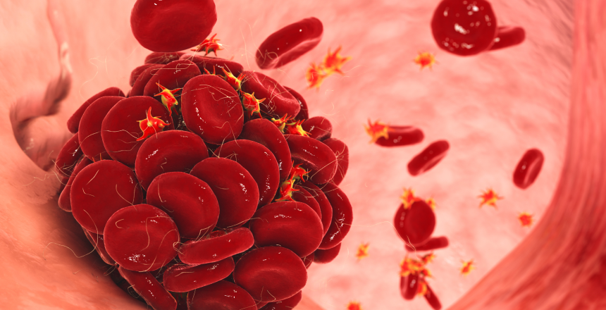 Mengenali Gejala dan Faktor Risiko Trombozis Sejak Dini